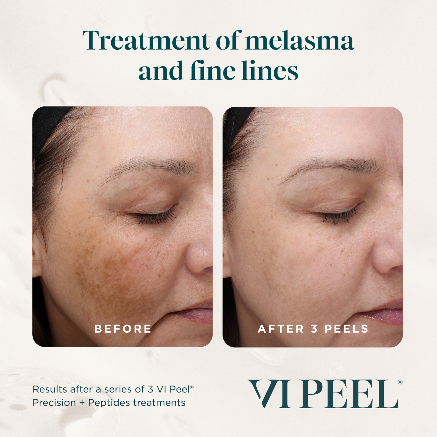 3 VI Peels