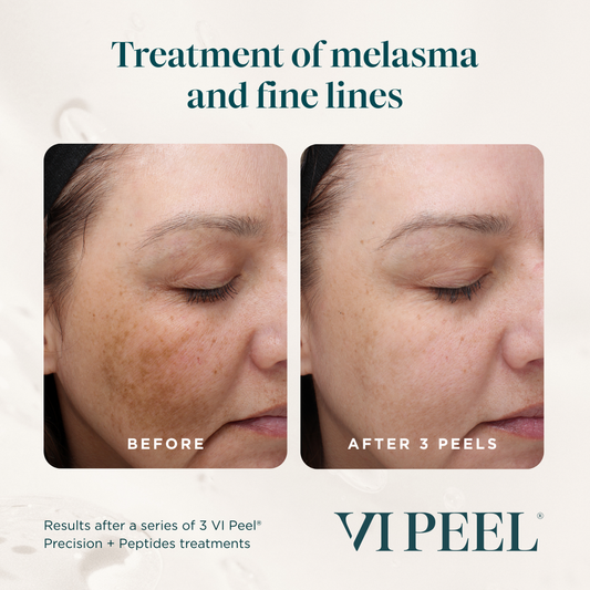 3 VI Peels